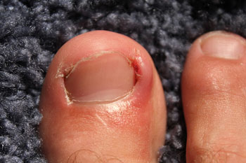 Ingrown toenails treatment in the New York County: Midtown Manhattan NY (Murray Hill, Rose Hill, Kips Bay, Nomad, Gramercy Park, Peter Cooper Village, Midtown East, West Village, Chelsea, Garment District) and Kings County: Brooklyn, NY (Dumbo, Сobble Hill, Boerum Hill, Carroll Gardens, Brooklyn Heights, Clinton Hill, Columbia Street Waterfront District, Gowanus, Vinegar Hill, Park Slope) areas