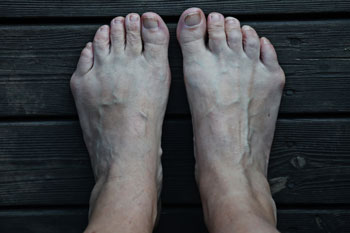 Bunions treatment in the New York County: Midtown Manhattan NY (Murray Hill, Rose Hill, Kips Bay, Nomad, Gramercy Park, Peter Cooper Village, Midtown East, West Village, Chelsea, Garment District) and Kings County: Brooklyn, NY (Dumbo, Сobble Hill, Boerum Hill, Carroll Gardens, Brooklyn Heights, Clinton Hill, Columbia Street Waterfront District, Gowanus, Vinegar Hill, Park Slope) areas