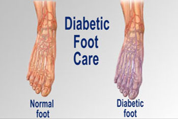 Diabetic foot treatment in the New York County: Midtown Manhattan NY (Murray Hill, Rose Hill, Kips Bay, Nomad, Gramercy Park, Peter Cooper Village, Midtown East, West Village, Chelsea, Garment District) and Kings County: Brooklyn, NY (Dumbo, Сobble Hill, Boerum Hill, Carroll Gardens, Brooklyn Heights, Clinton Hill, Columbia Street Waterfront District, Gowanus, Vinegar Hill, Park Slope) areas