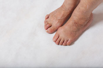 Hammertoes treatment in the New York County: Midtown Manhattan NY (Murray Hill, Rose Hill, Kips Bay, Nomad, Gramercy Park, Peter Cooper Village, Midtown East, West Village, Chelsea, Garment District) and Kings County: Brooklyn, NY (Dumbo, Сobble Hill, Boerum Hill, Carroll Gardens, Brooklyn Heights, Clinton Hill, Columbia Street Waterfront District, Gowanus, Vinegar Hill, Park Slope) areas