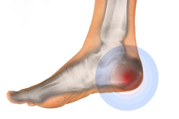 Plantar Fasciitis Specialist in NYC · Manhattan Foot Specialists