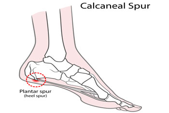 Heel spurs treatment in the New York County: Midtown Manhattan NY (Murray Hill, Rose Hill, Kips Bay, Nomad, Gramercy Park, Peter Cooper Village, Midtown East, West Village, Chelsea, Garment District) and Kings County: Brooklyn, NY (Dumbo, Сobble Hill, Boerum Hill, Carroll Gardens, Brooklyn Heights, Clinton Hill, Columbia Street Waterfront District, Gowanus, Vinegar Hill, Park Slope) areas