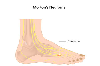 Mortons' neuroma treatment in the New York County: Midtown Manhattan NY (Murray Hill, Rose Hill, Kips Bay, Nomad, Gramercy Park, Peter Cooper Village, Midtown East, West Village, Chelsea, Garment District) and Kings County: Brooklyn, NY (Dumbo, Сobble Hill, Boerum Hill, Carroll Gardens, Brooklyn Heights, Clinton Hill, Columbia Street Waterfront District, Gowanus, Vinegar Hill, Park Slope) areas