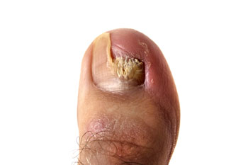 The Best Fungal Nail Treatments  The Feet People Podiatry