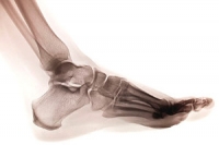 How a Stress Fracture Occurs